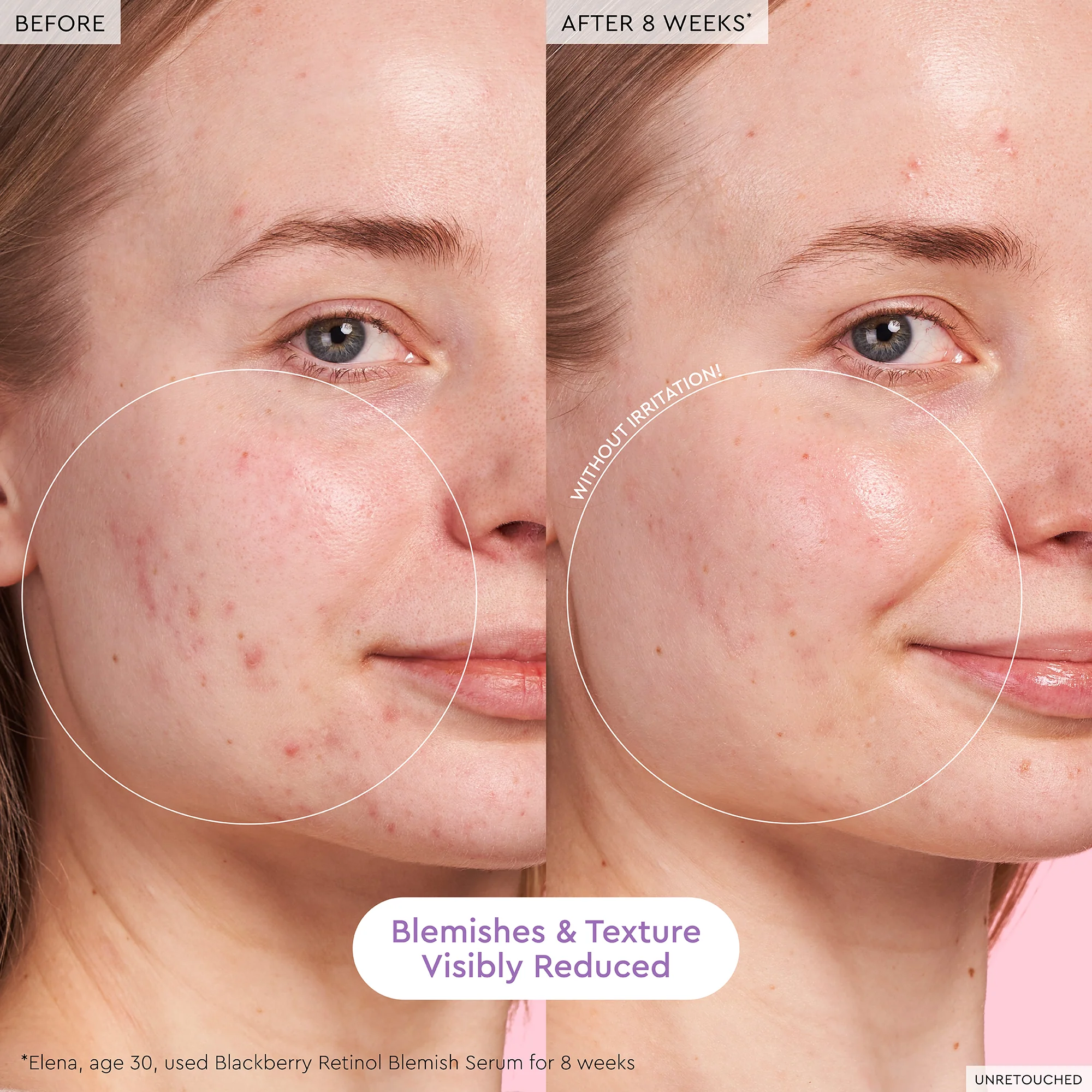 33-blackberry-retinol-blemish-serum-3.webp Blackberry Retinol Blemish Serum
